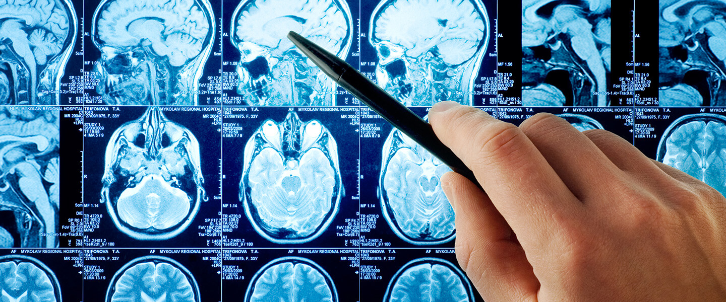 Unique Neural Activation Pattern in People With Co-Occurring Bipolar Disorder and Alcohol Use Disorder Points to Future Treatment Targets
Unique Neural Activation Pattern in People With Co-Occurring Bipolar Disorder and Alcohol Use Disorder Points to Future Treatment Targets