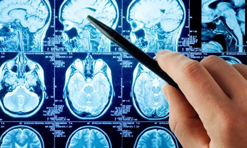 Specific Connectivity Changes and Linked Changes in White Matter Are Associated with PTSD Symptom Reduction in Clinical Trial Results